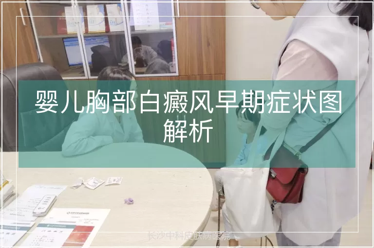 婴儿胸部白癜风早期症状图解析