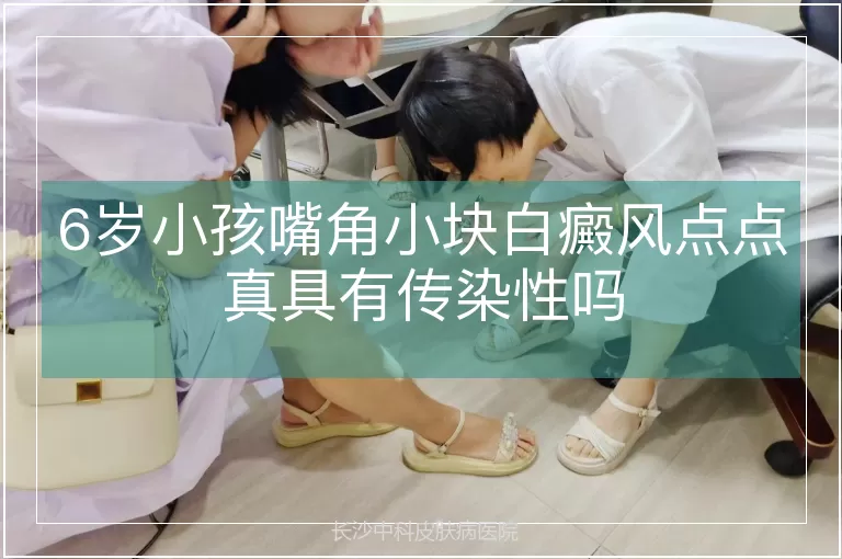 6岁小孩嘴角小块白癜风点点真具有传染性吗