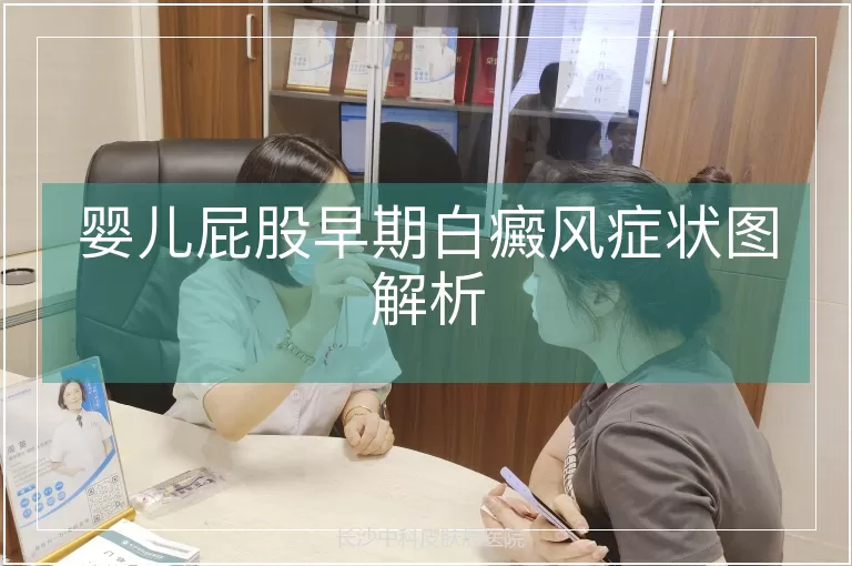 婴儿屁股早期白癜风症状图解析