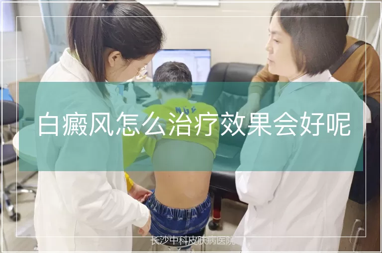 白癜风怎么治疗效果会好呢