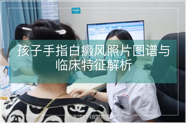 孩子手指白癜风照片图谱与临床特征解析
