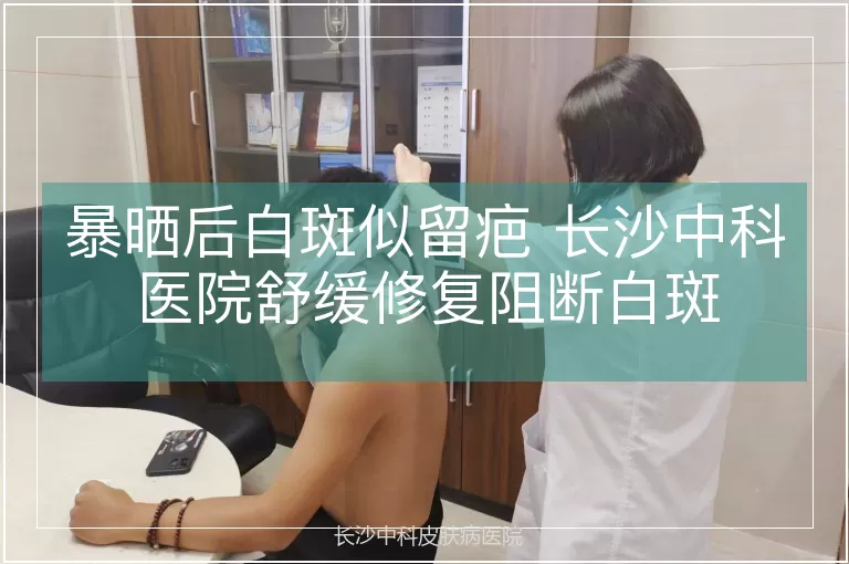 暴晒后白斑似留疤 长沙中科医院舒缓修复阻断白斑