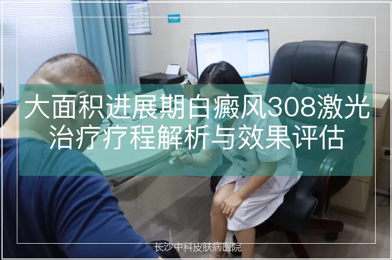 大面积进展期白癜风308激光治疗疗程解析与效果评估