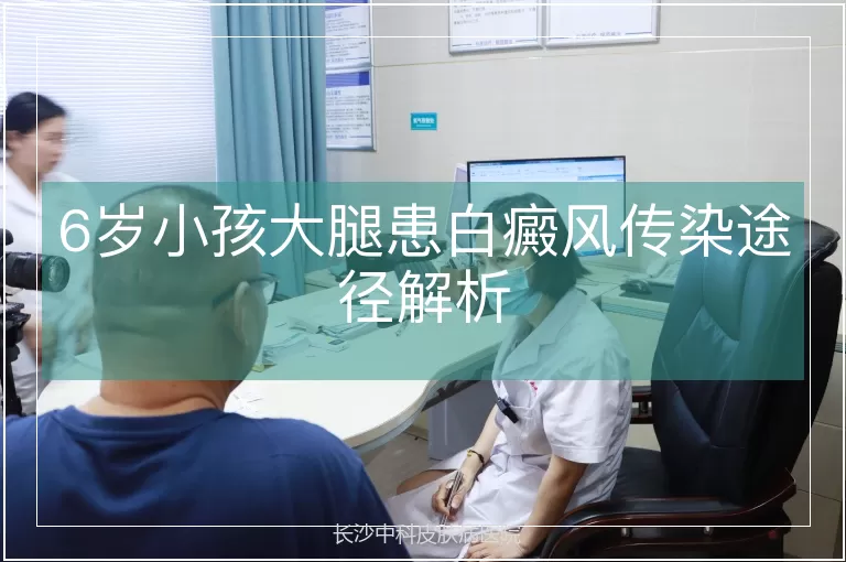 6岁小孩大腿患白癜风传染途径解析