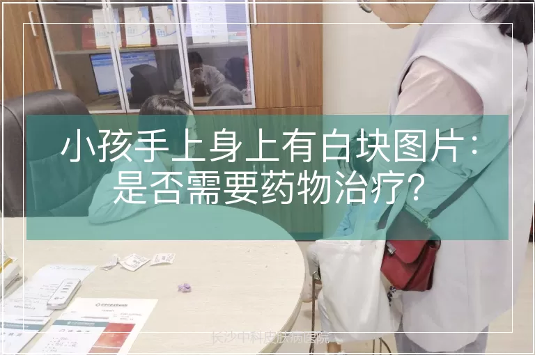 小孩手上身上有白块图片：是否需要药物治疗？