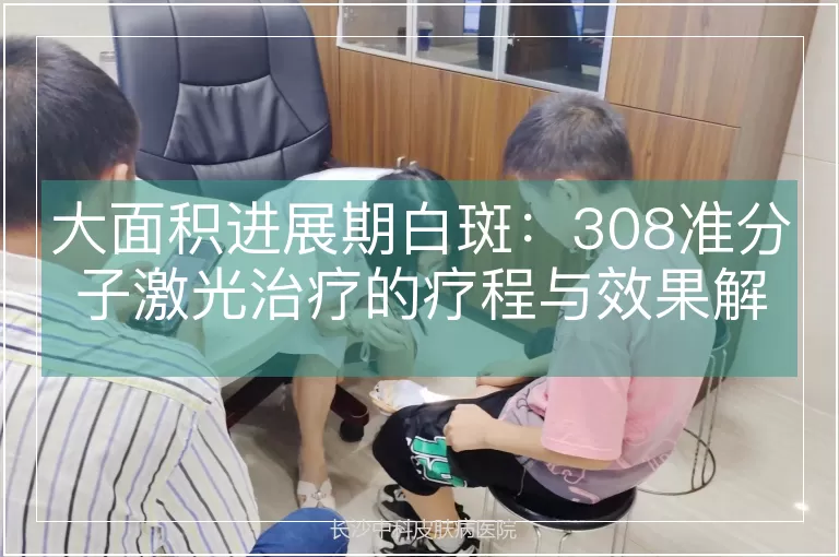 大面积进展期白斑：308准分子激光治疗的疗程与效果解析