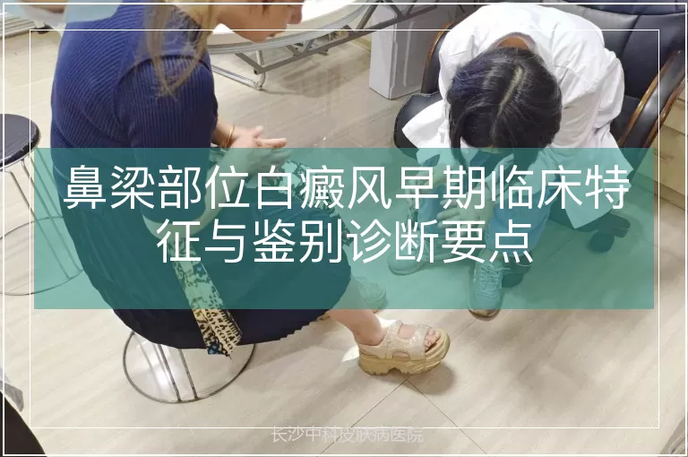 鼻梁部位白癜风早期临床特征与鉴别诊断要点
