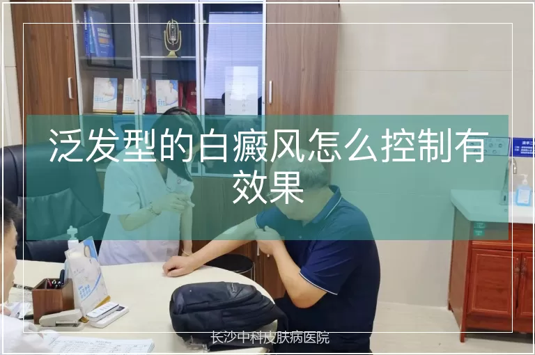 泛发型的白癜风怎么控制有效果