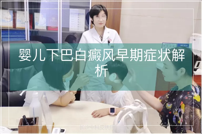 婴儿下巴白癜风早期症状解析