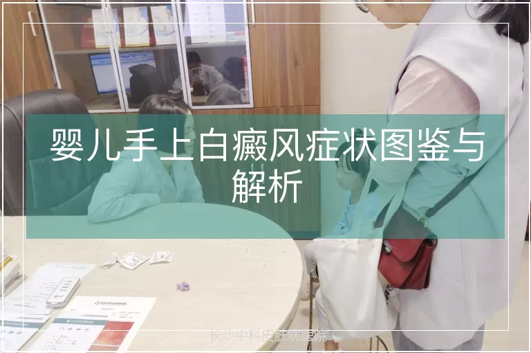 婴儿手上白癜风症状图鉴与解析