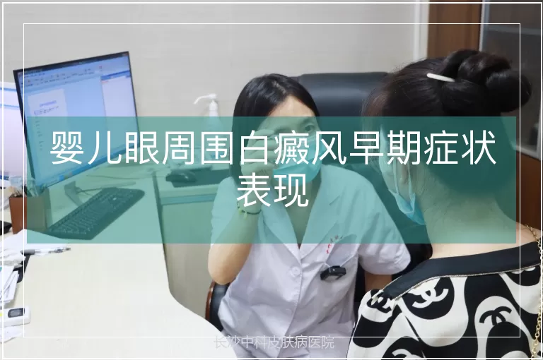 婴儿眼周围白癜风早期症状表现