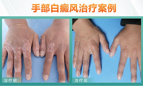 男，10岁，1年半手部白癜风图